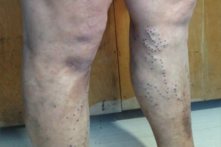 淤积性皮炎小腿皮肤发黑图