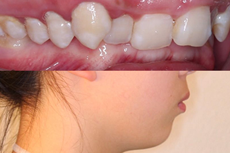 骨性凸嘴上颌前突图