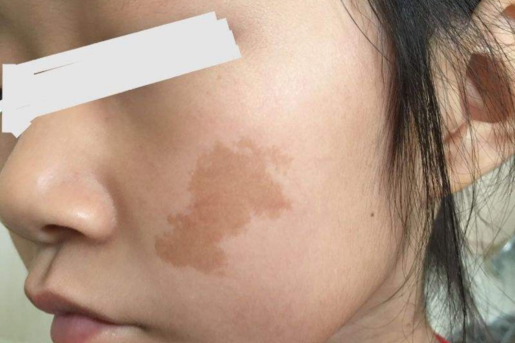 咖啡斑脸上黑斑图