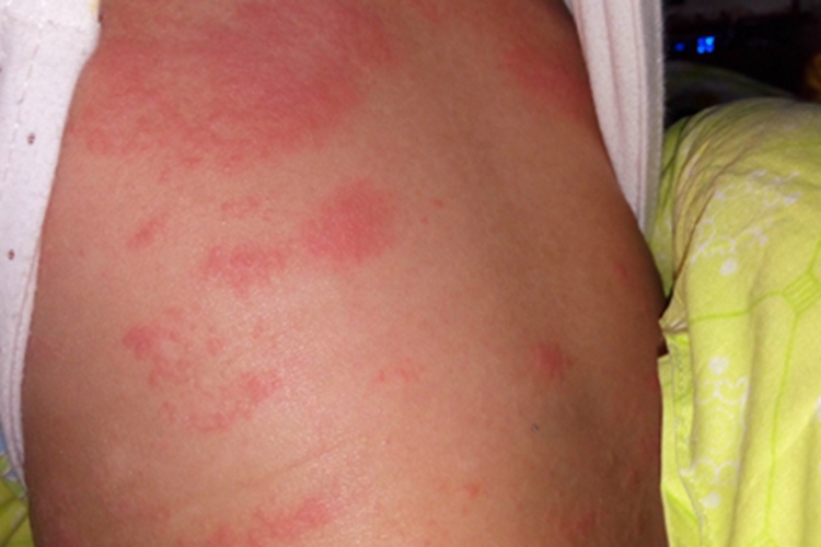 渗出型婴儿湿疹背部症状图