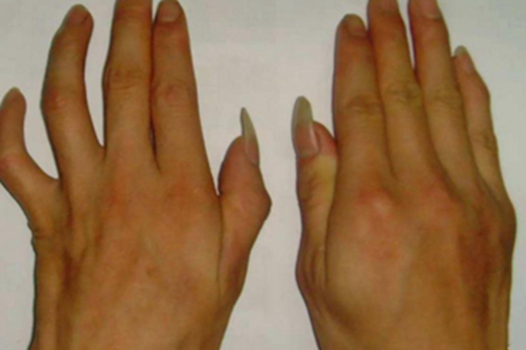 肩手综合征手部变形活动障碍图 肩手综合征手部变形活动障碍图