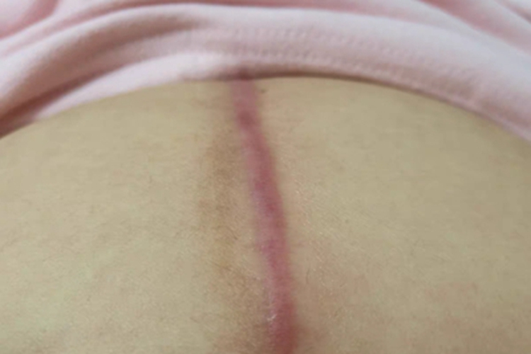 瘢痕疙瘩腹部有一条瘢痕图 瘢痕疙瘩腹部有一条瘢痕图