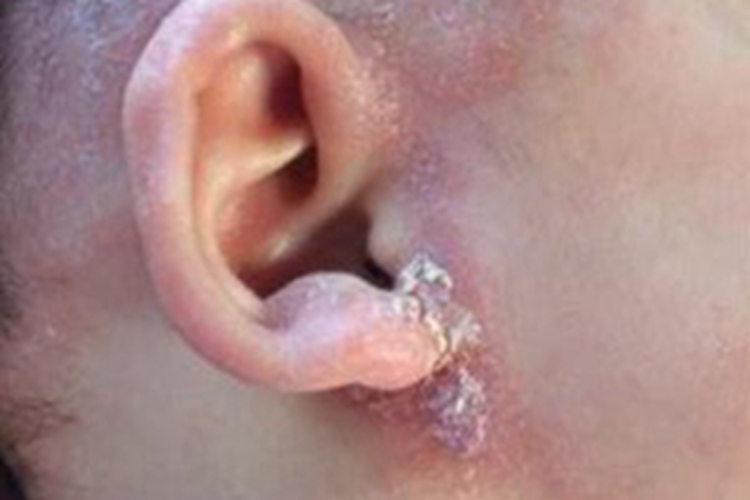 外耳湿疹耳朵糜烂结痂图