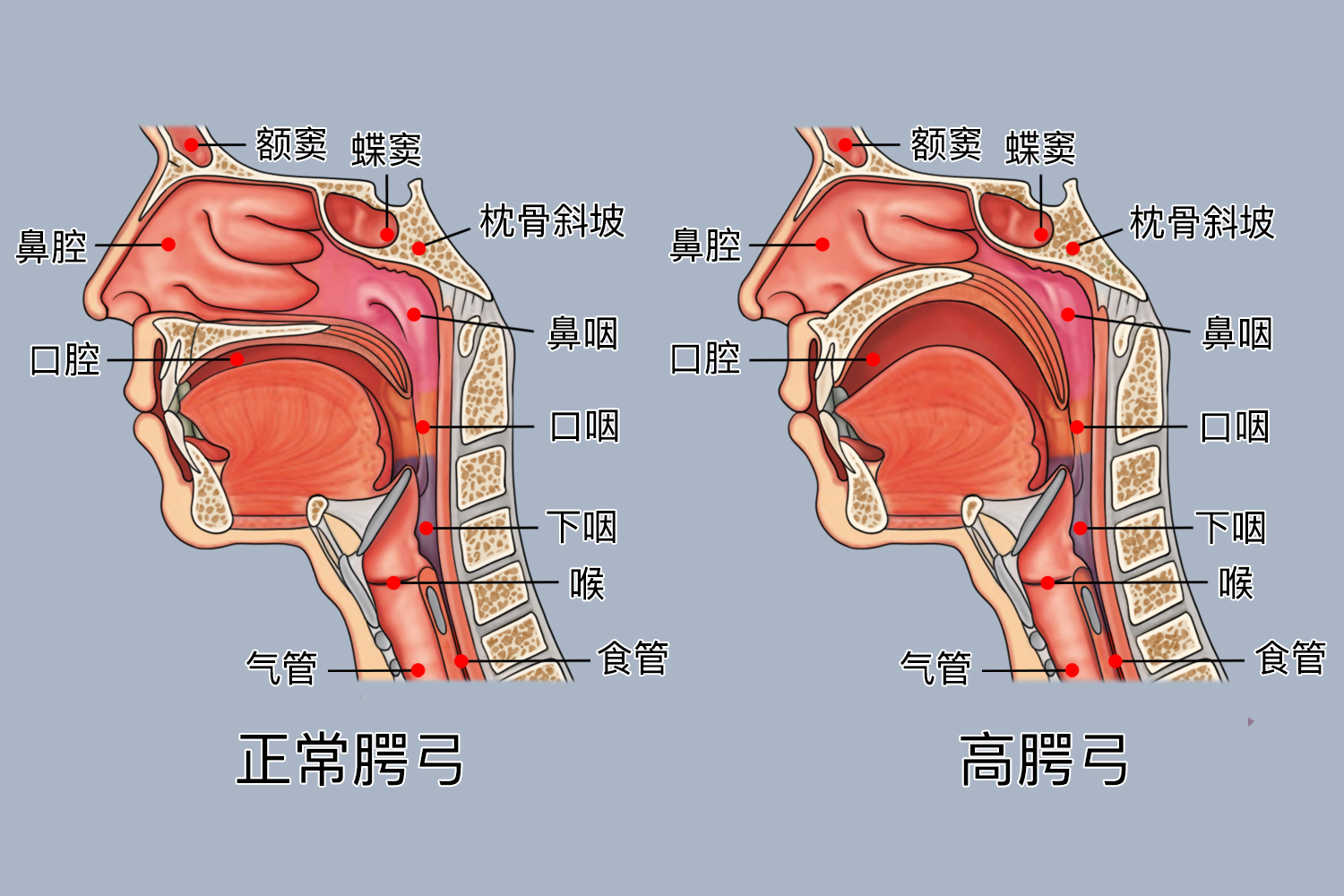 正常腭弓与高腭弓区别图