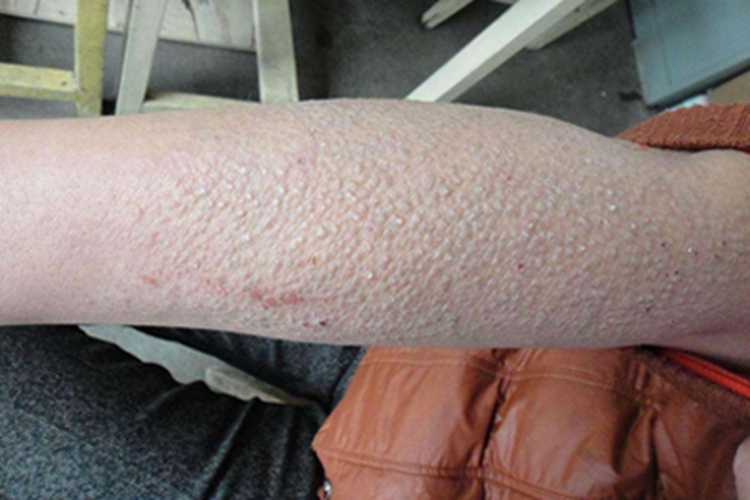 继发性皮肤淀粉样变胳膊小疙瘩图 继发性皮肤淀粉样变胳膊小疙瘩图