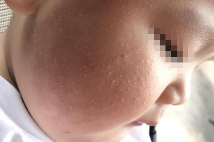 儿童毛周角化症图