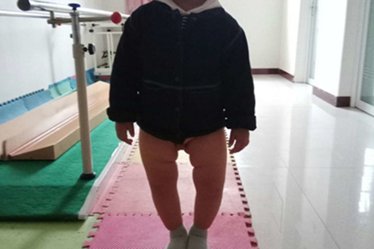 膝内翻下肢中间有空隙图 膝内翻下肢中间有空隙图