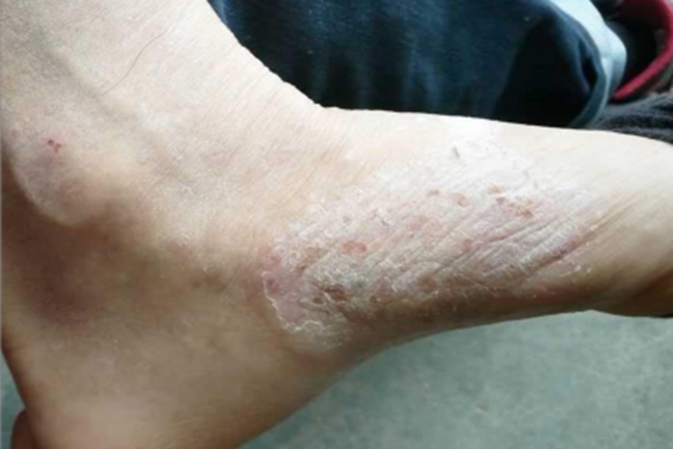 丹毒样型癣菌疹脚背症状图