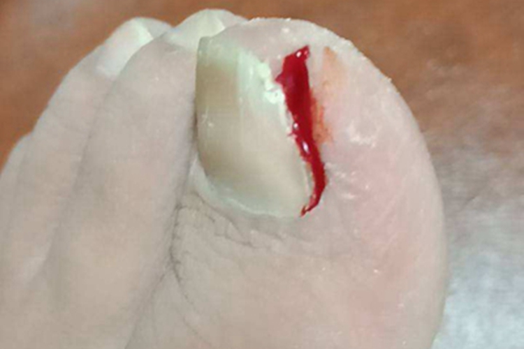 慢性甲沟炎裂口图 慢性甲沟炎裂口图