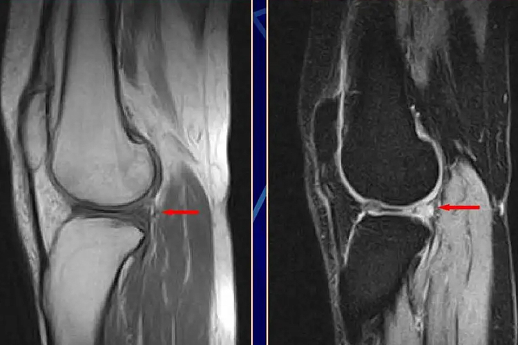 半月板内侧后角撕裂图