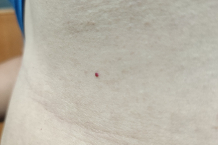 毛细血管瘤腹部有红点图 毛细血管瘤腹部有红点图