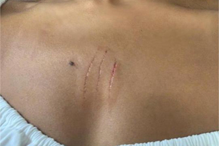 抓伤胸部裂纹图