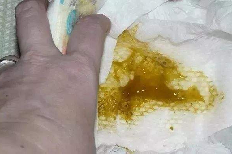 腹型过敏性紫癜黏液便图