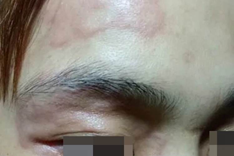 皮肤过敏红肿前额症状图
