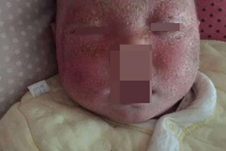 干燥型婴儿湿疹面部脱皮图 干燥型婴儿湿疹面部脱皮图