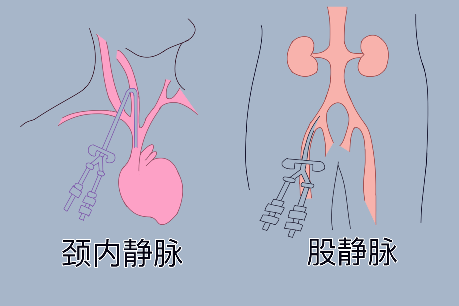 置入中心静脉导管图