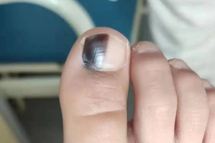 大脚趾头甲母痣图