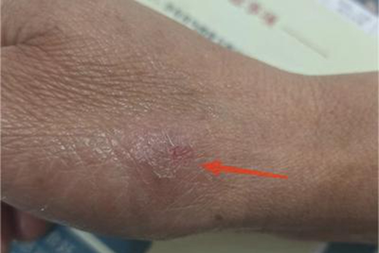 慢性湿疹手部增厚图