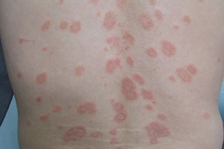 玫瑰糠疹背部症状图 玫瑰糠疹背部症状图
