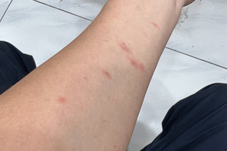 跳蚤叮咬胳膊小红疙瘩图