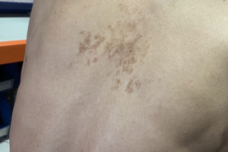 慢性湿疹背部症状图