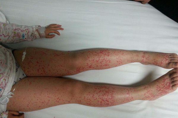 过敏性紫癜小腿红点图