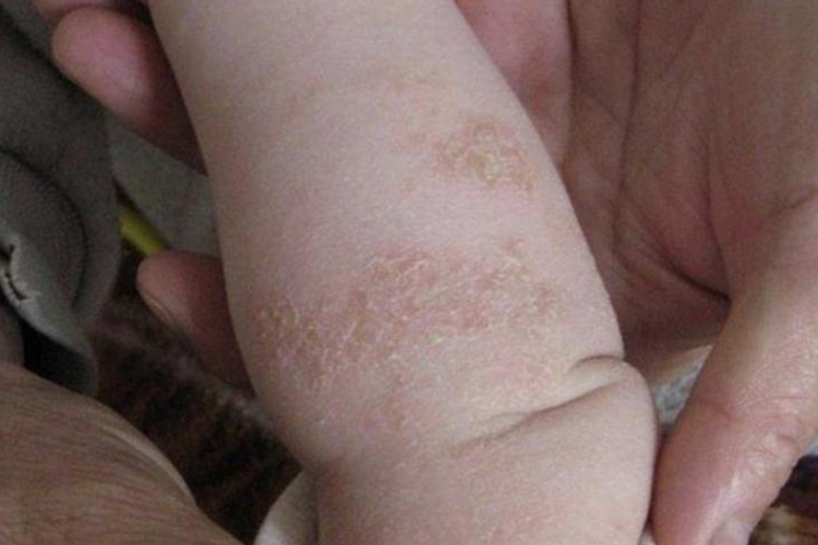 婴儿银屑病鳞屑图 婴儿银屑病鳞屑图