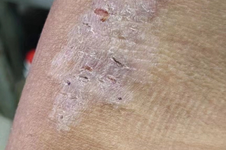 慢性湿疹胳膊脱屑图 慢性湿疹胳膊脱屑图