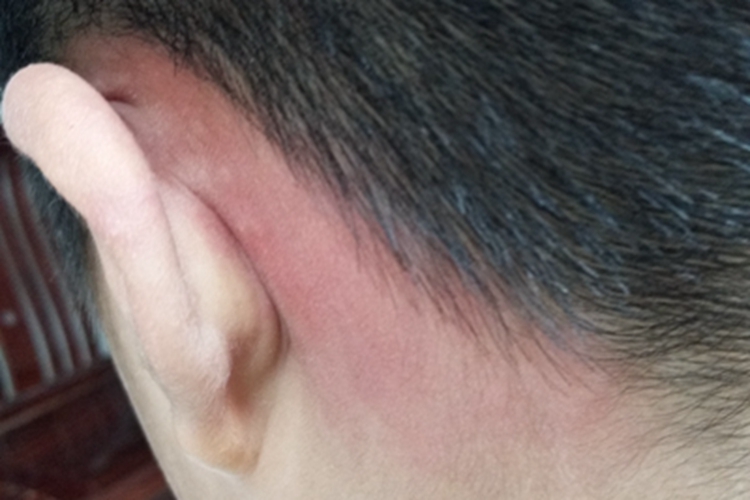 荨麻疹耳后红斑图