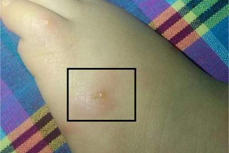 虫咬皮炎脚背水疱图