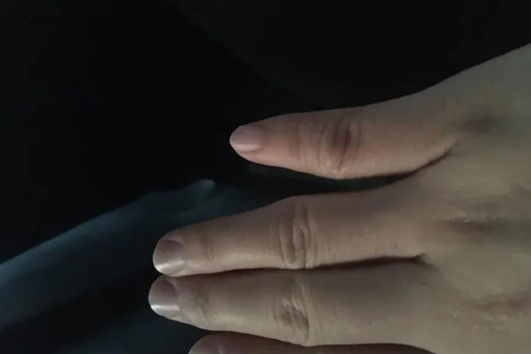 小指营养不良图