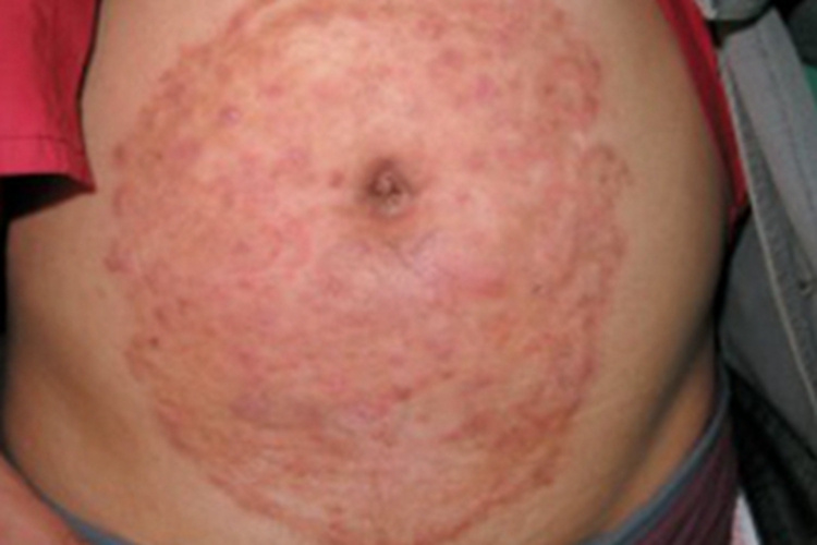 艾滋病感染性皮肤损害腹部症状图 艾滋病感染性皮肤损害腹部症状图