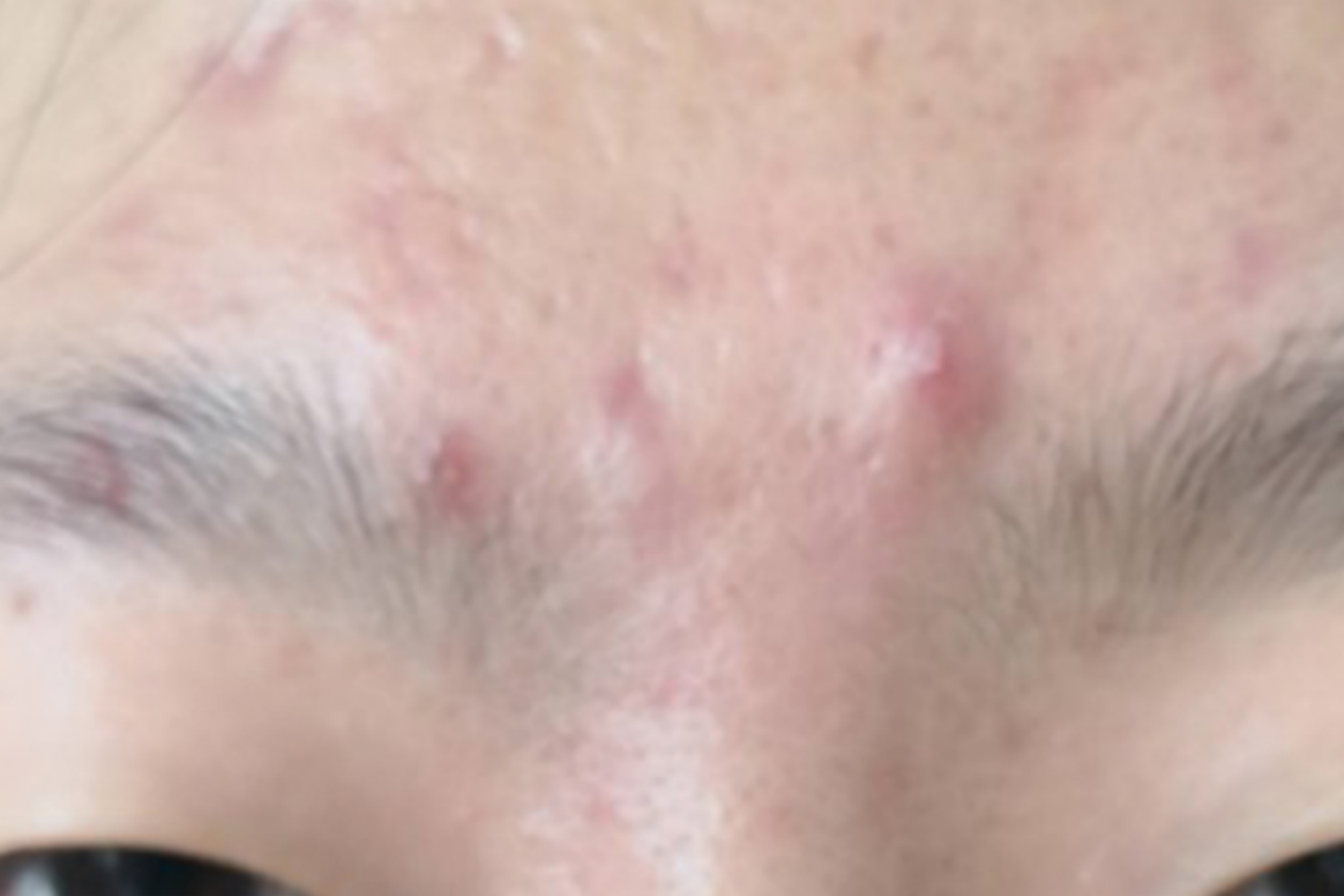 蠕形螨病痤疮状丘疹图 蠕形螨病痤疮状丘疹图