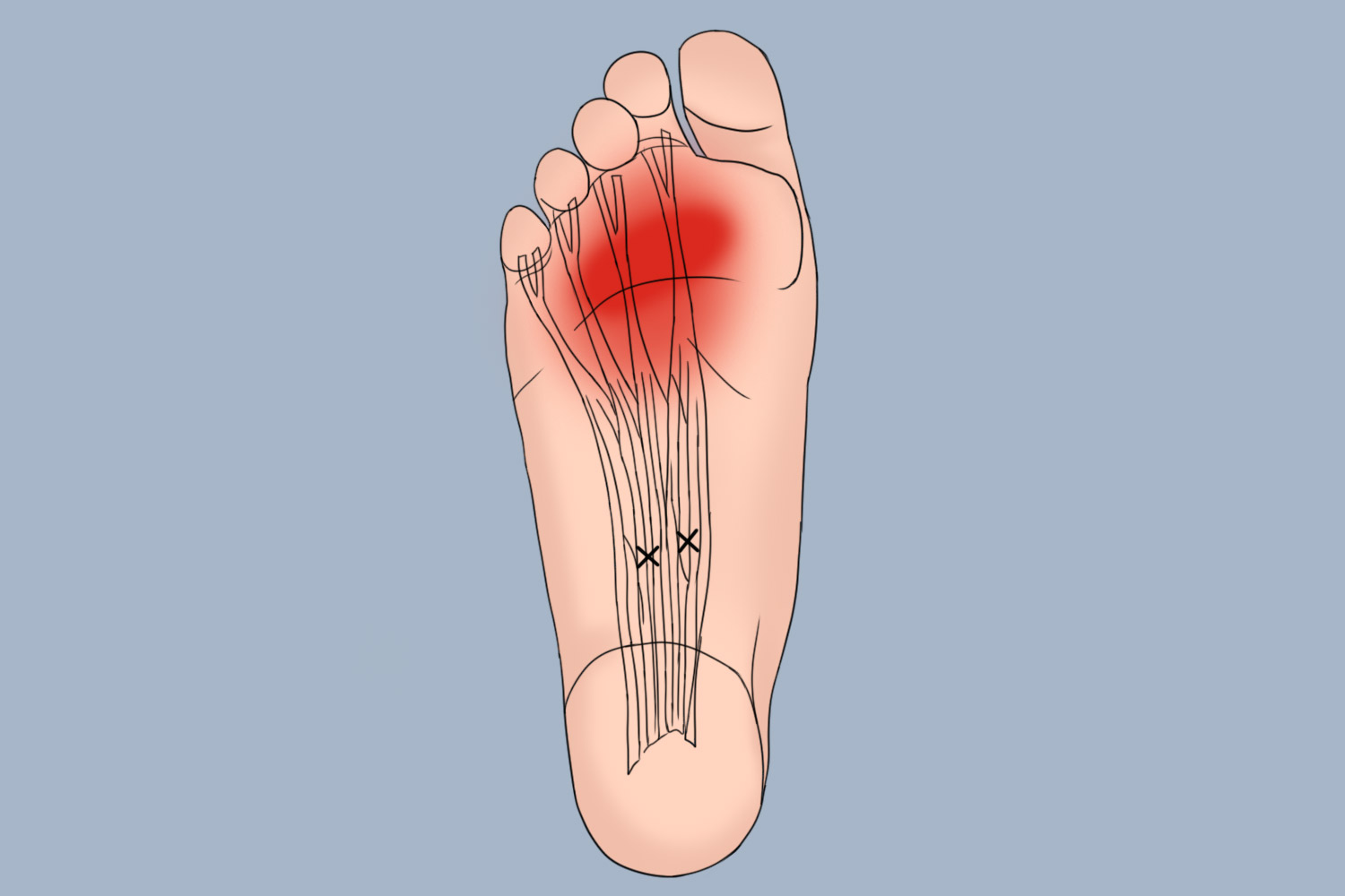 前脚掌筋膜炎疼痛部位指的是脚趾根部至脚底凹陷处之间的部位,疼痛在