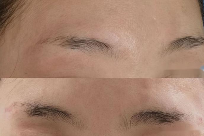 无创洗眉1-2天变化图