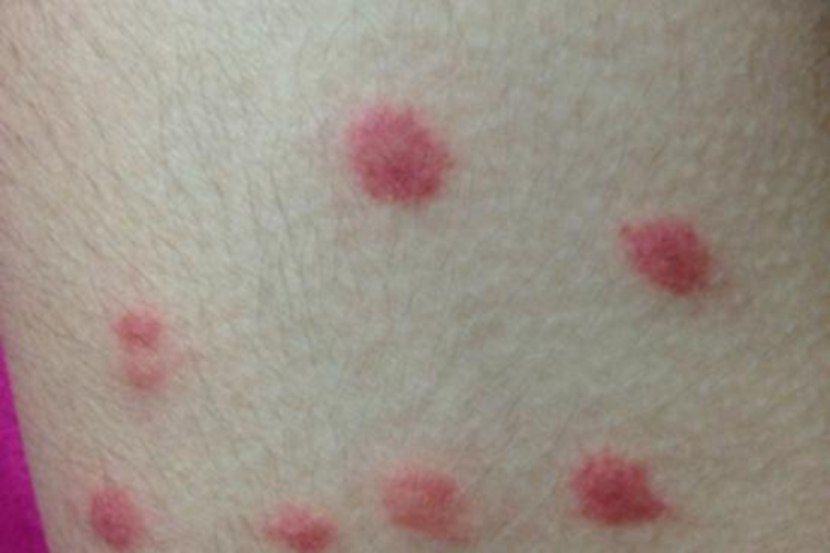 人被臭虫咬过图