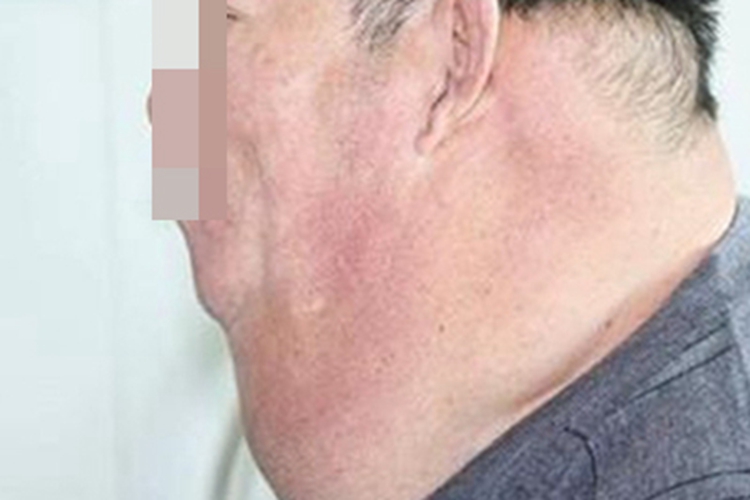 良性对称性脂肪过多症颈部肿块图