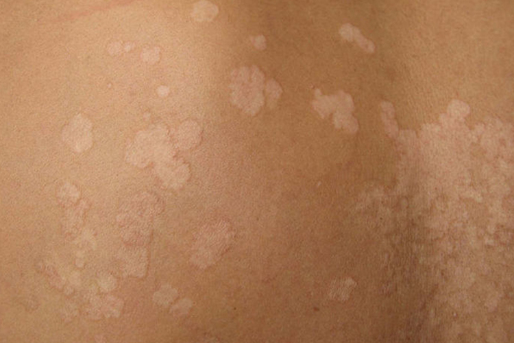 背部白色糠疹图