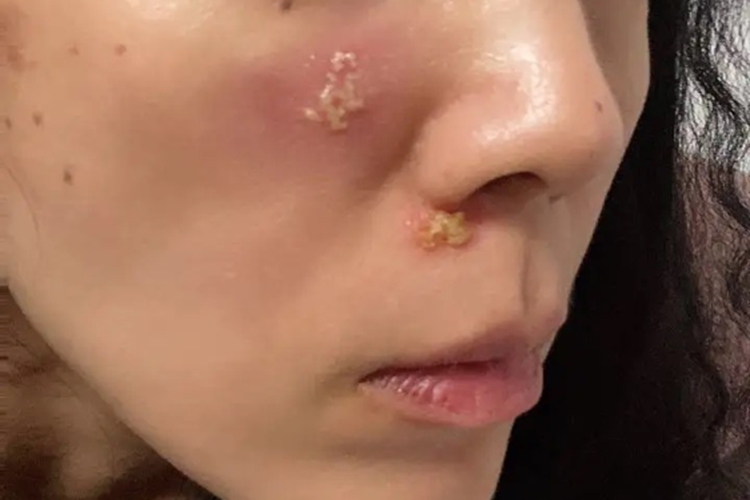 鼻翼一侧长疱疹图 鼻翼一侧长疱疹图