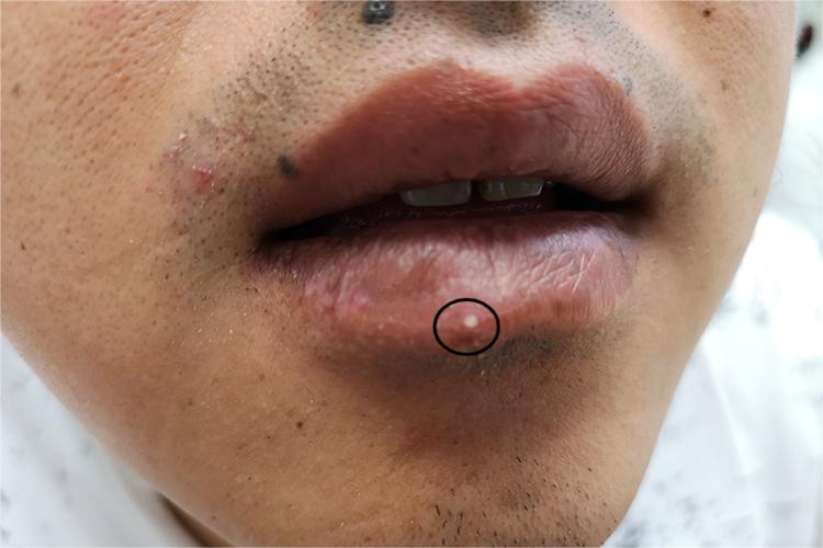 下唇皮脂腺异位症图