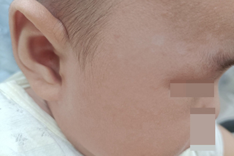 花斑癣额头有两片白斑图