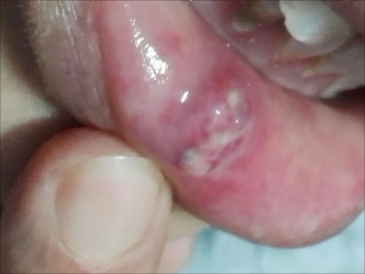 口腔黏膜结核性溃疡下嘴唇内侧起水疱图.jpg