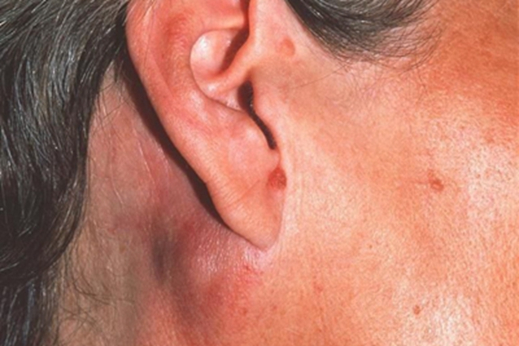 霍奇金病包块图