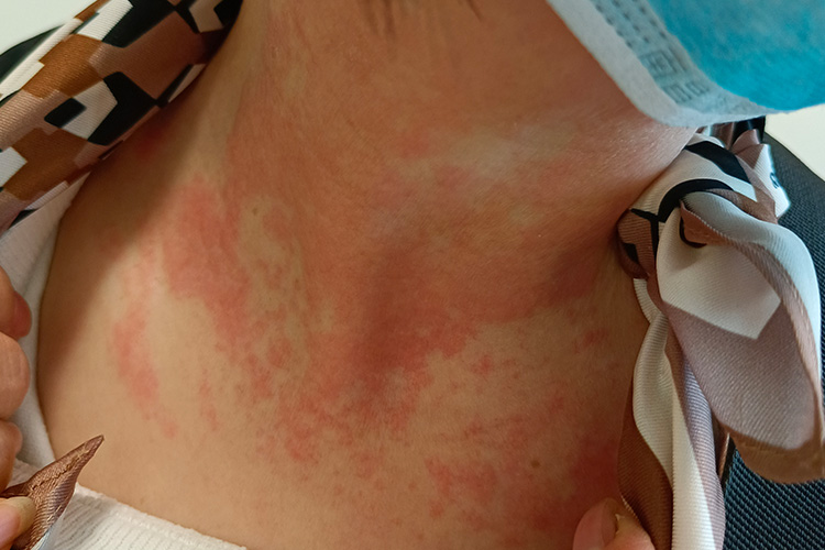 接触性皮炎红疹图