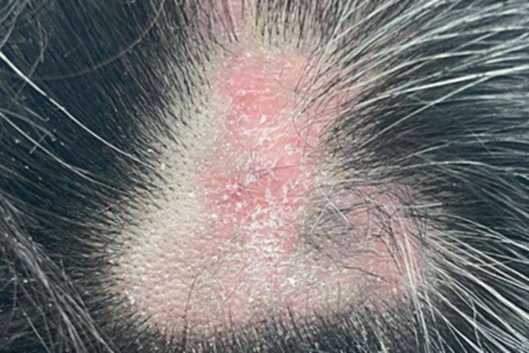扁平苔藓头皮有红斑脱屑图
