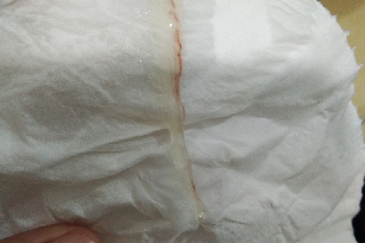 小便后擦拭白带有血丝图 小便后擦拭白带有血丝图