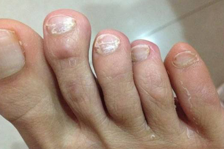 脚白色浅表型甲真菌病图