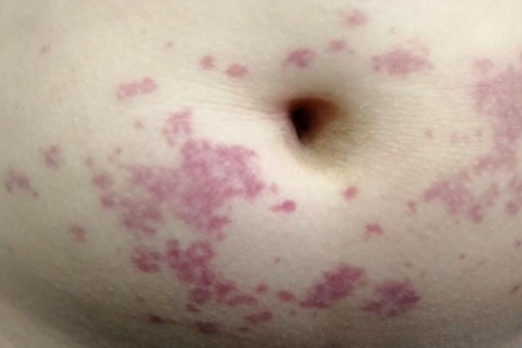 异常蛋白血症紫癜红斑图