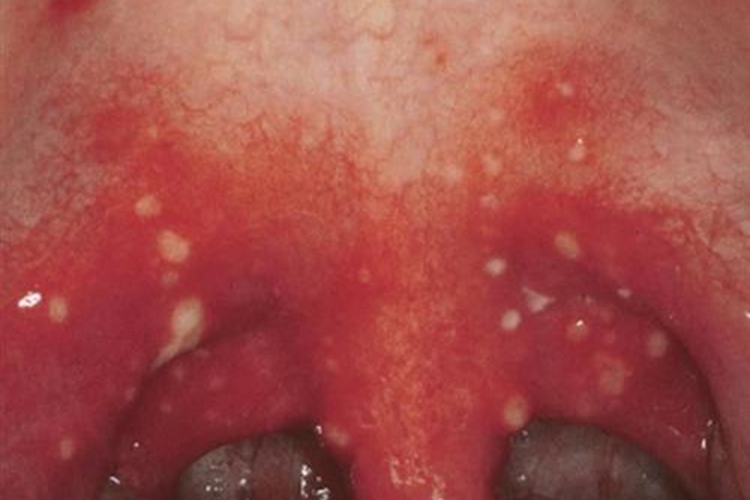 疱疹性咽炎起脓包图 疱疹性咽炎起脓包图