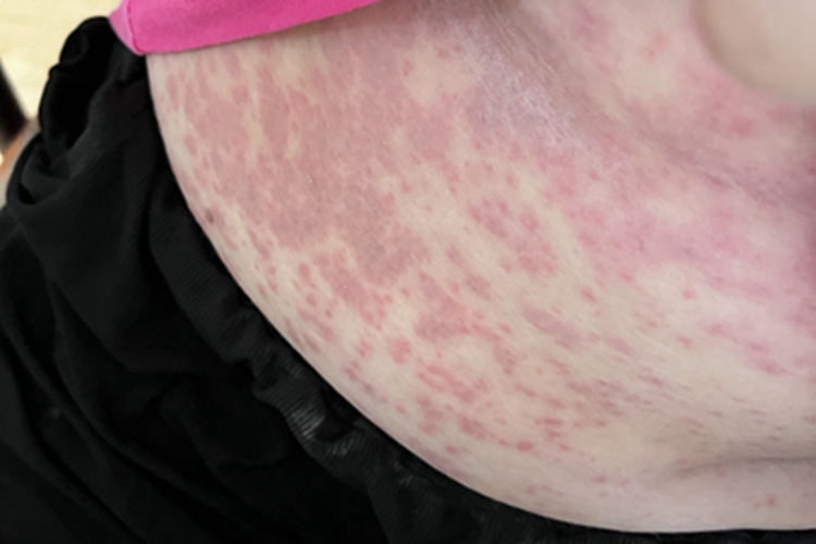 急性接触性皮炎腹部丘疹图